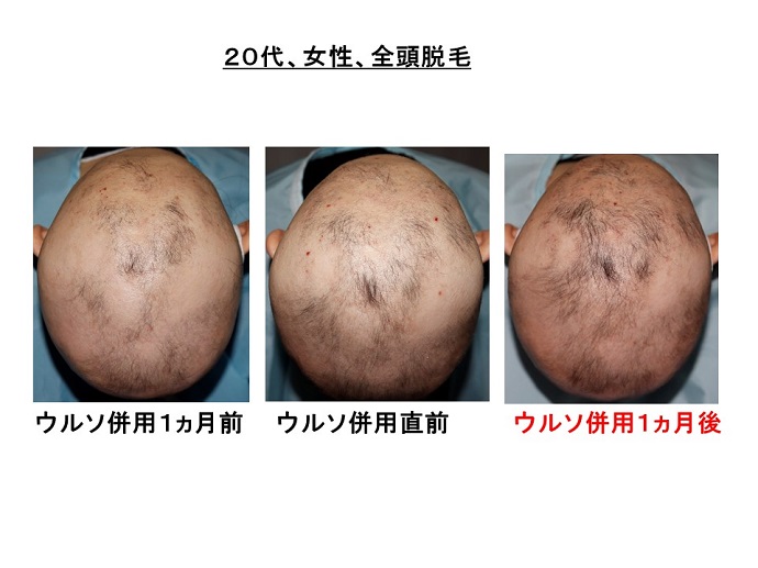 円形脱毛症　病院